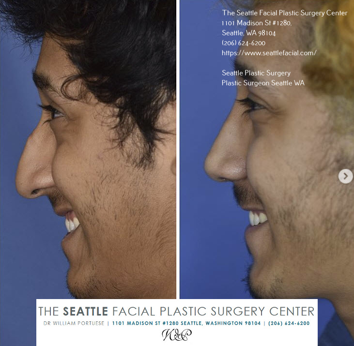 natural rhinoplasty